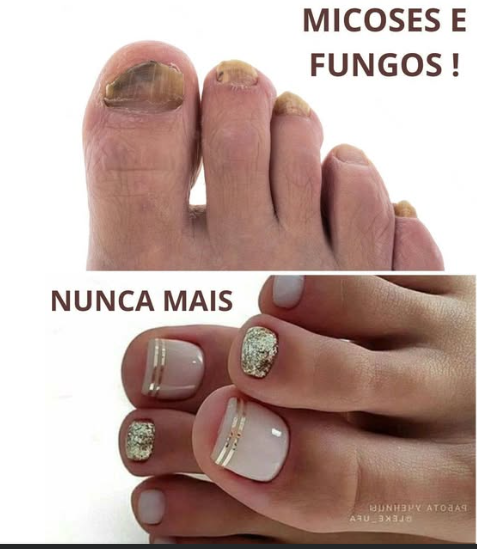 COMO TRATAR MICOSE E FUNGOS COM RECEITA CAEIRA