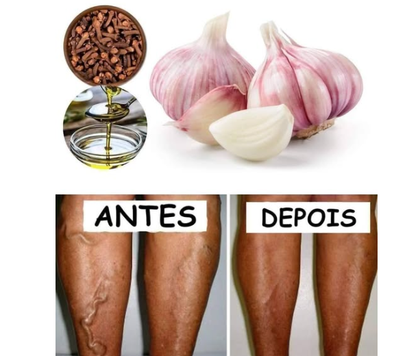 RECEITA CASEIRA PARA ACABAR COM AS VARIZES